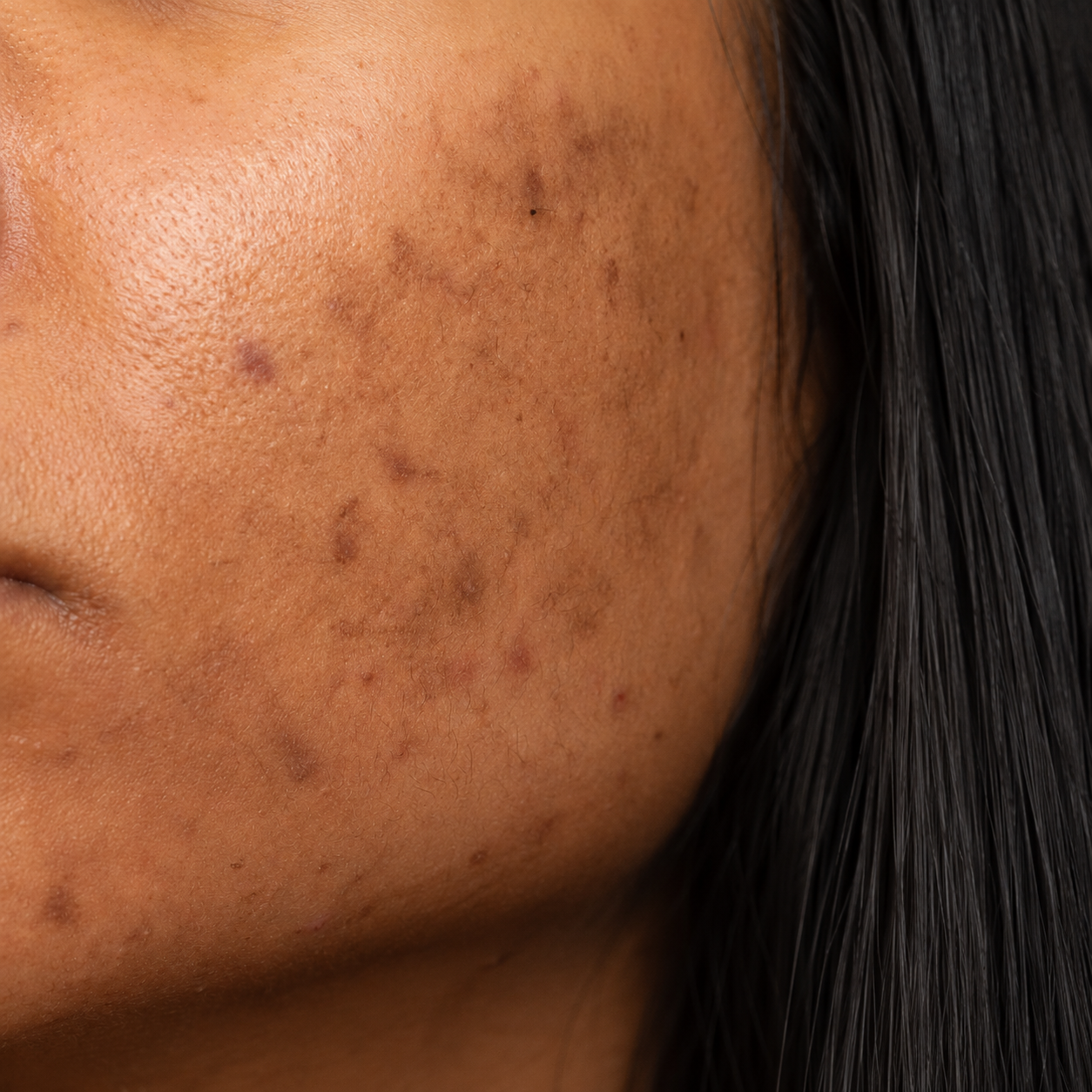 Dark spots